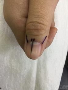 甲母痣手术过程视频,专业操作与术后护理全解析